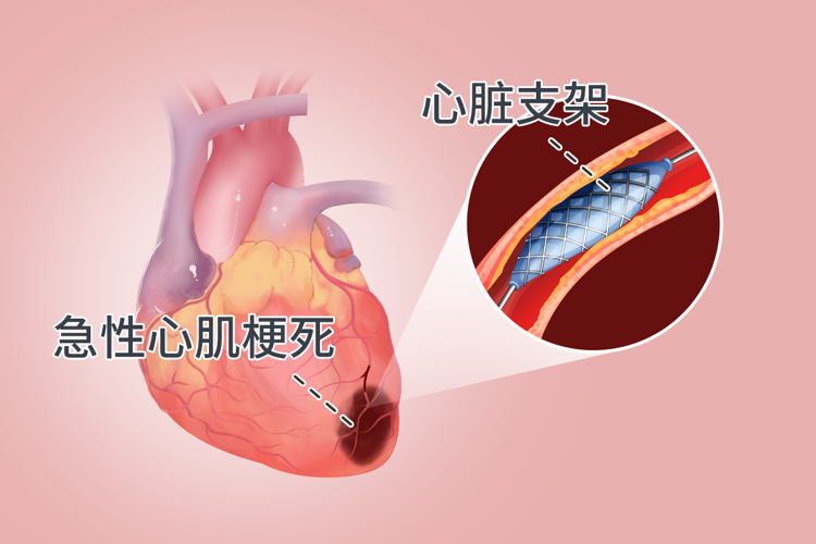 心臟支架手術(shù)：到底是治病救人還是“缺德害人”？告訴你真相