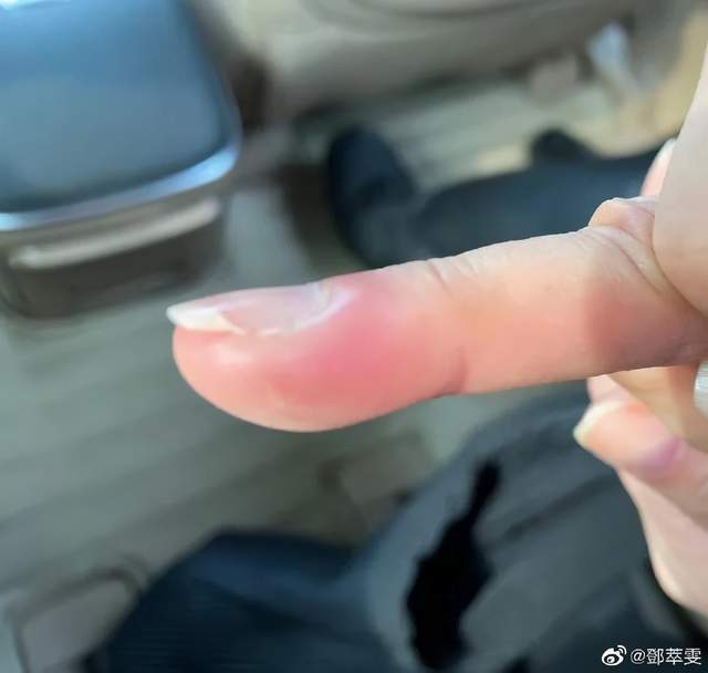知名女演員拔倒刺做手術(shù)上了熱搜！醫(yī)生緊急提醒