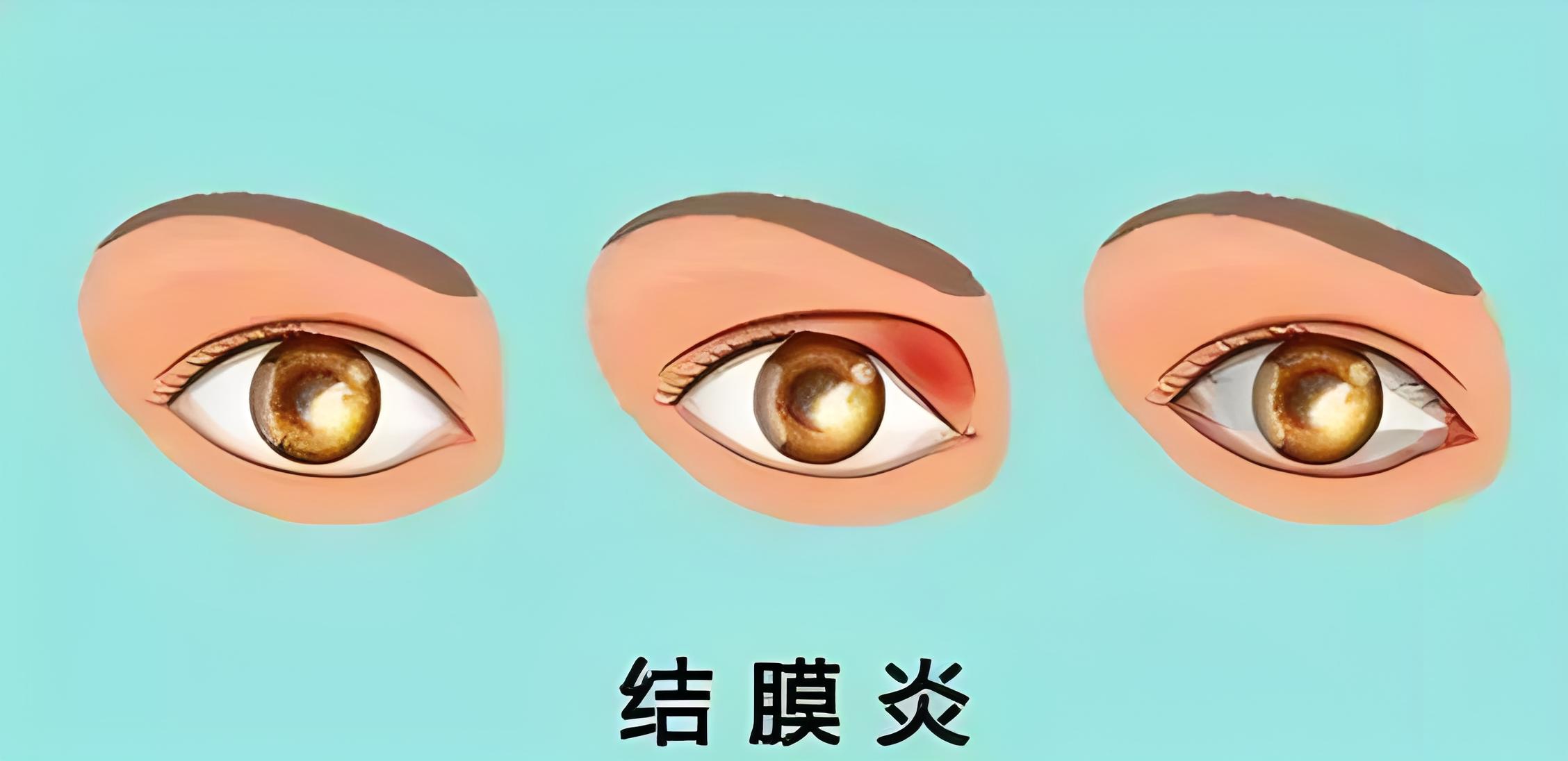 春暖花開，氣溫回暖：如何應(yīng)對過敏性結(jié)膜炎?