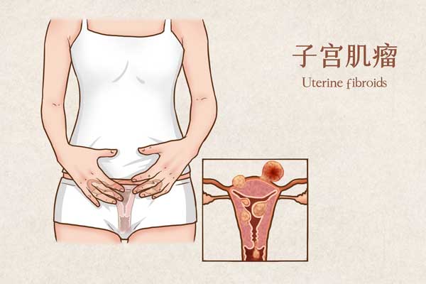 子宮肌瘤術(shù)后應(yīng)該怎么保健
